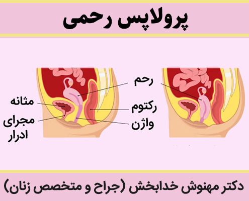 پرولاپس-رحمی