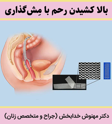 بالا-کشیدن-رحم-با-مِشگذاری
