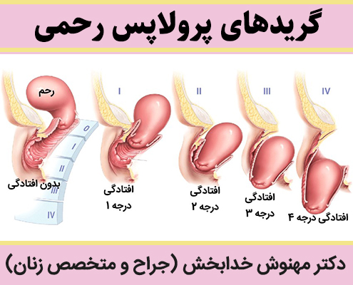گریدهای-پرولاپس-رحمی