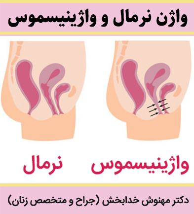 نمودار آناتومی مقایسه واژن نرمال و انقباض غیرارادی عضلات کف لگن در واژینیسموس